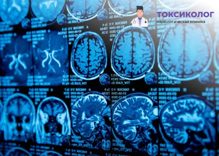 Снимки МРТ головного мозга при диагностике последствий употребления веществ, лечение зависимости анонимно.